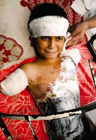 Photo of Iraqi boy crying in hospital bed, his two arms are short stumps with bandages, there is a bandage on his head and his body is burned and there is some kind of white medical cream on his torso