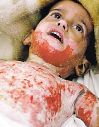 photo of a two or three year-old baby lying on his or her back, mouth open and worried eyes wide, bloody red patches of skin all over the chin and chest and tiny arm