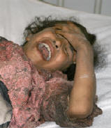 Photo of a little black-haired girl crying in pain and anguish as she lies in a hospital bed, her hand over her forehead. This photo doesn't show it, but other photos have shown that this girl has severe wounds to her left leg, and lesser wounds to her right leg.