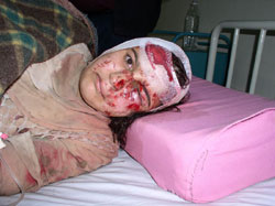 Photo of a wounded girl, the left side of her face bloodied and swollen, left eye closed, white bandage around her head with bloodstains on her forehead; she is lying on her side on a hospital bed, her right eye wide open and staring at the viewer.