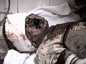 horrible photo of a dead child with dried blood and lacerations all over his face and mouth, and dried blood on the front of his sweater. He is lying on his back on a hospital bed with a wide white bandage around the top of his head, covering his eyes.